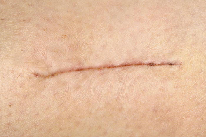 Hypertrophic scars